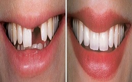 dental implants in Islamabad,Pakistan