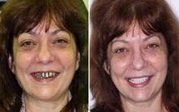 dental implants