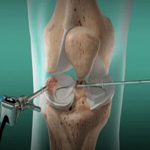 Arthroscopic surgery in Islamabad