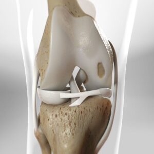 Cartilage Restoration in Islamabad