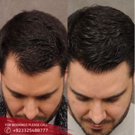 Hair Transplant before and after in Islamabad