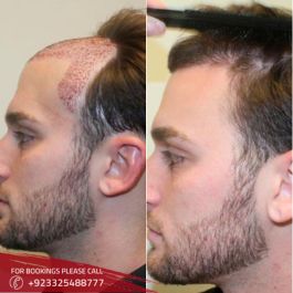 Hair Transplant cost in Islamabad
