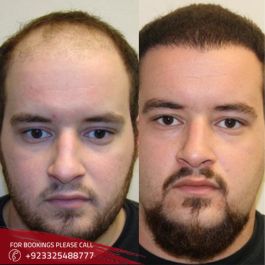 Hair Transplant in Islamabad 