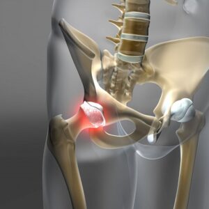 Hip Replacement in Islamabad