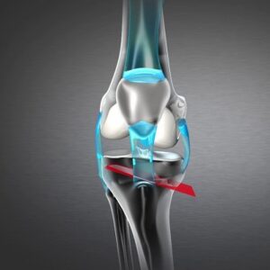 Knee Osteotomies in Islamabad