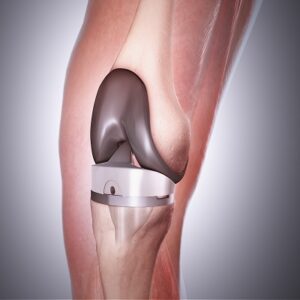 Knee Replacement in Islamabad