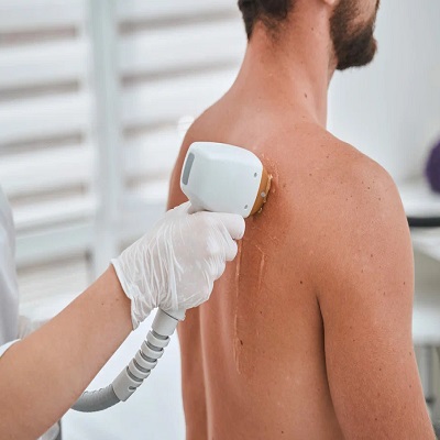 Laser Hair Removal in Islamabad