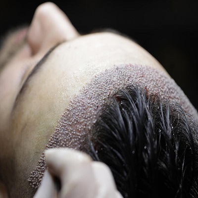Hair Transplant in Islamabad