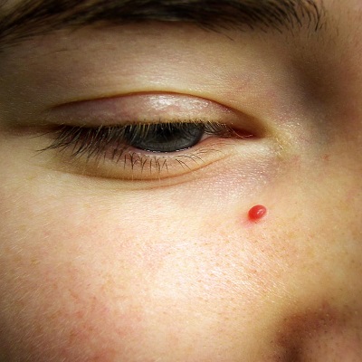 Hemangiomas Treatment in Islamabad