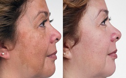Melasma Treatment price in Islamabad