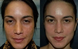 Melasma Treatment