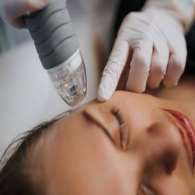 Microneedling in Islamabad / Virtue RF Micro needling