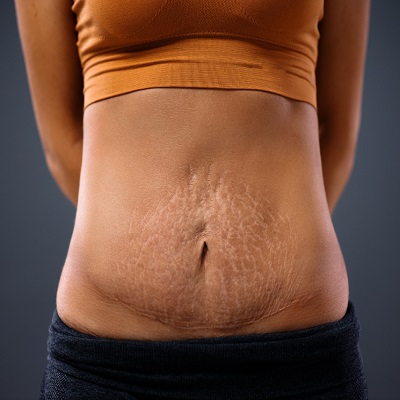 Stretch Mark Removal in Islamabad