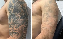 Tattoo Removal in Islamabad,Pakistan