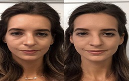 Under Eye Fillers Islamabad