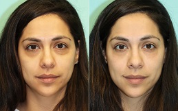 Under Eye Fillers cost in Islamabad