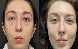 Under Eye Fillers in Islamabad