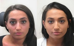 Under Eye Fillers price in Islamabad