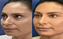 Under Eye Fillers