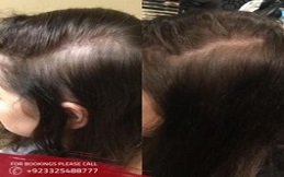 Best-PRP-Hair-Loss-Treatment-in-Islamabad-Rawalpindi-