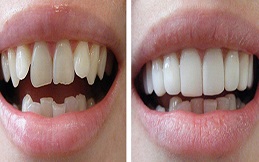 Best Veneers in Islamabad