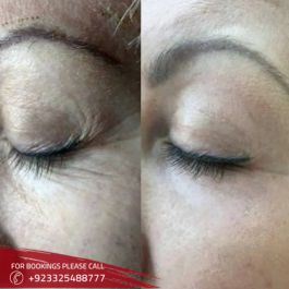 Botox in Islamabad.Pakistan