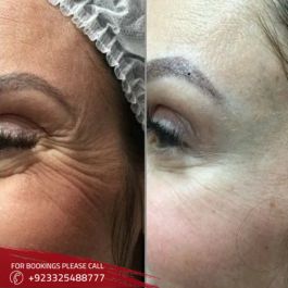 Botox injection Islamabad