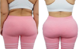 Buttock-Lift-before-after-in-Islamabad