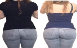 Buttock-Lift-cost-in-Islamabad