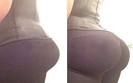 Buttock Lift