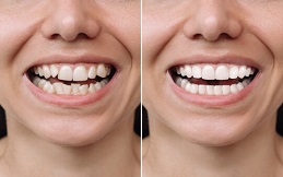 Dental Veneers in Pakistan