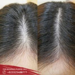 Exosomes Hair Therapy 