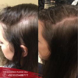 Exosomes Hair Therapy in Islamabad 