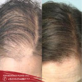 Exosomes Hair in Islamabad