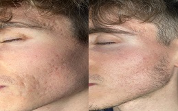 Fractional CO2 Skin Resurfacing before after in Islamabad