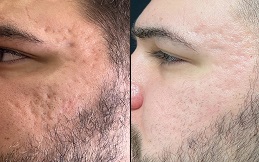 Fractional CO2 Skin Resurfacing in Islamabad,Pakistan