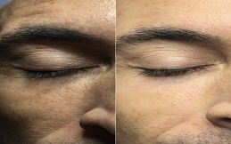 Fractional CO2 Skin Resurfacing