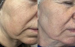 Fractional CO2 Skin Resurfacing