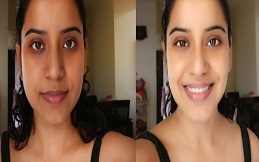 Full Body Whitening Injection in Islamabad