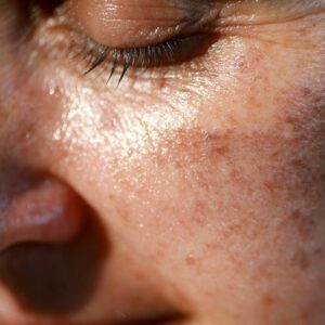 Melasma Treatment Cost in Islamabad