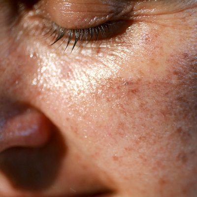 Melasma treatment cost in Islamabad