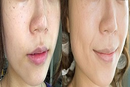 PICO Laser Treatment