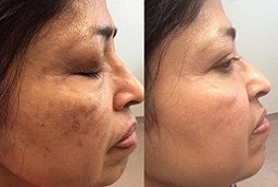 PICO Laser Treatment in Islamabad,Pakistan