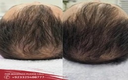 PRP-Hair-Loss-Treatment-in-Islamabad-Rawalpindi