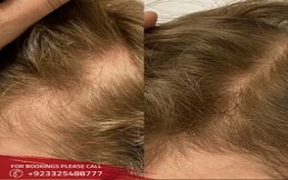 PRP hair treatment