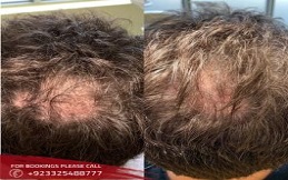PRP hair treatment in Islamabad