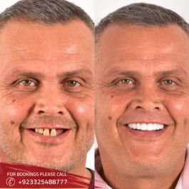 Root canal before and after