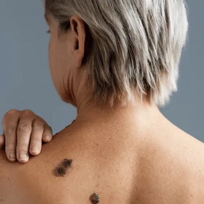 Seborrheic Keratosis Treatment in Islamabad