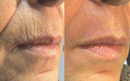 Skin Resurfacing in Islamabad,Pakistan