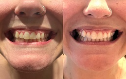 Teeth Whitening cost in Islamabad